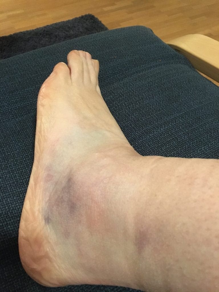 It's been quite a year for us. This is Mum's broken ankle from a year ago.